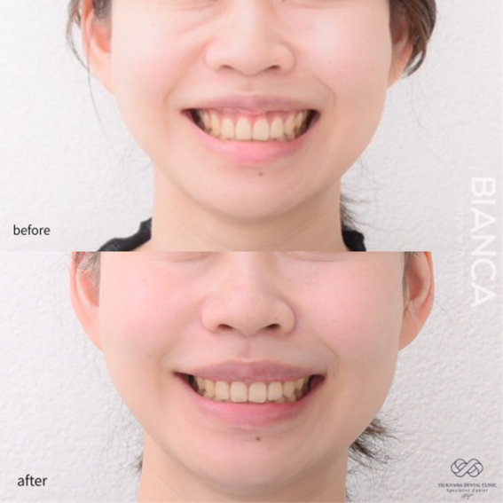 審美的歯冠長延長術・リップリポジショニング