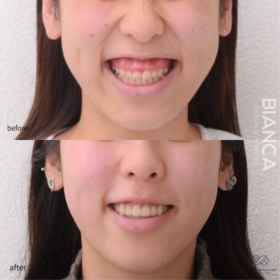 審美的歯冠長延長術・ボトックス注射