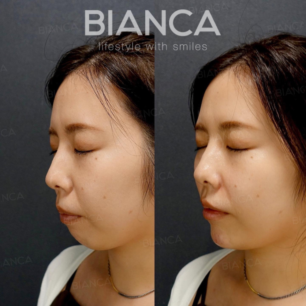 鼻と顎のヒアルロン酸注入