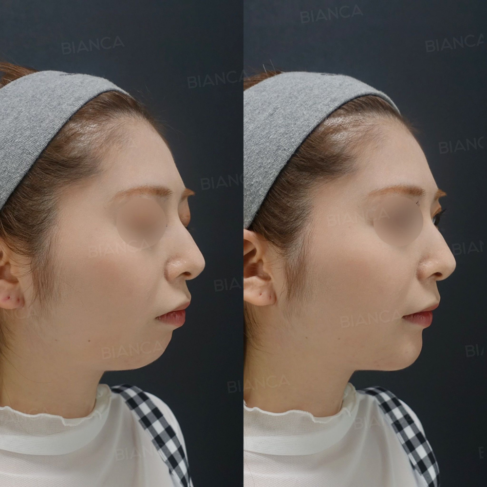 鼻と顎のヒアルロン酸注入