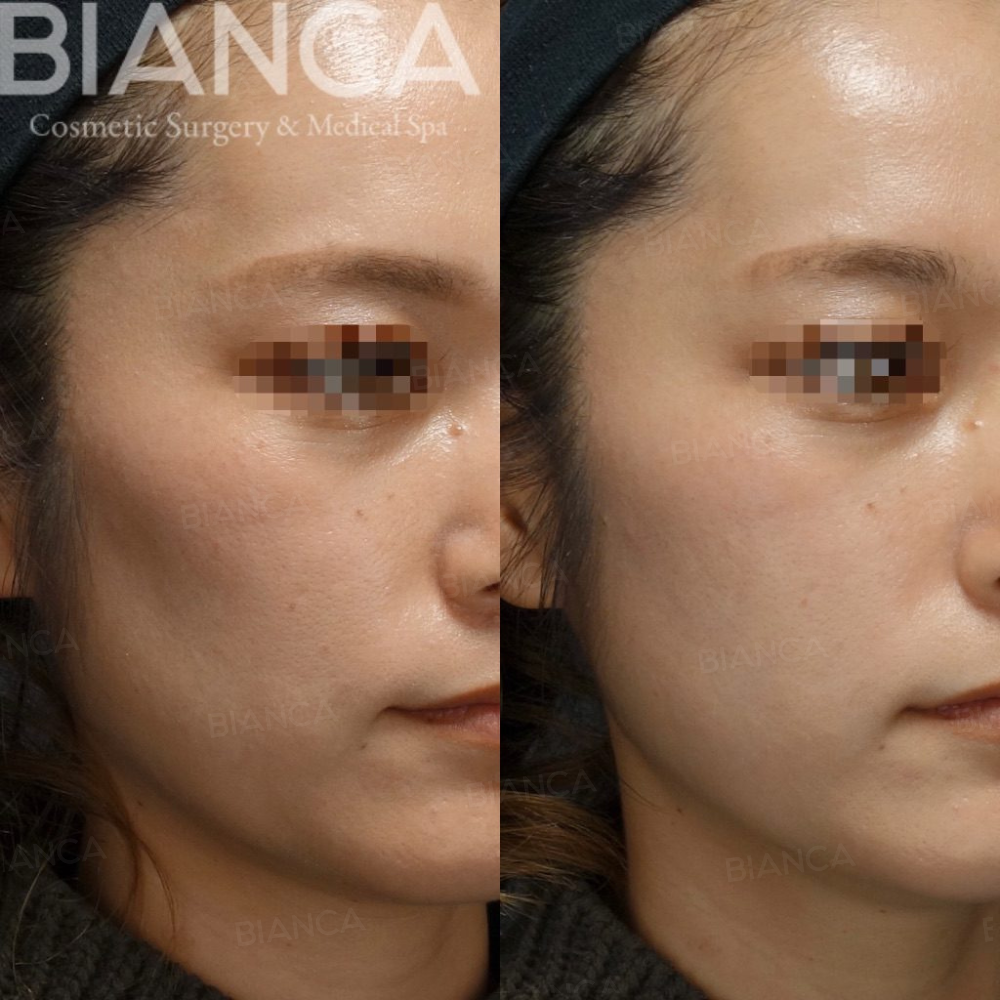 ヒアルロン酸注射（頬こけ）