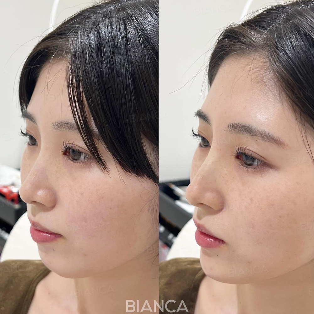 Eライン（顎・鼻）ヒアルロン酸注入