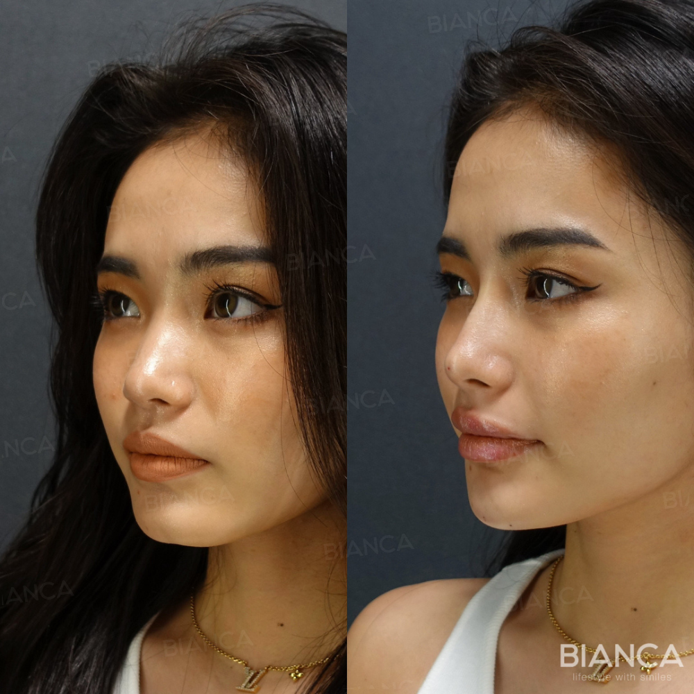 Eライン（顎・鼻・唇）ヒアルロン酸注入