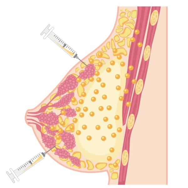 【豊胸】脂肪注入で作る自然なバスト！魅力とリアルを医師が解説｜銀座・表参道にあるBIANCA CLINIC ビアンカクリニック｜美容外科・美容皮膚科・再生医療・美容婦人科・美容内科・医療アートメイク