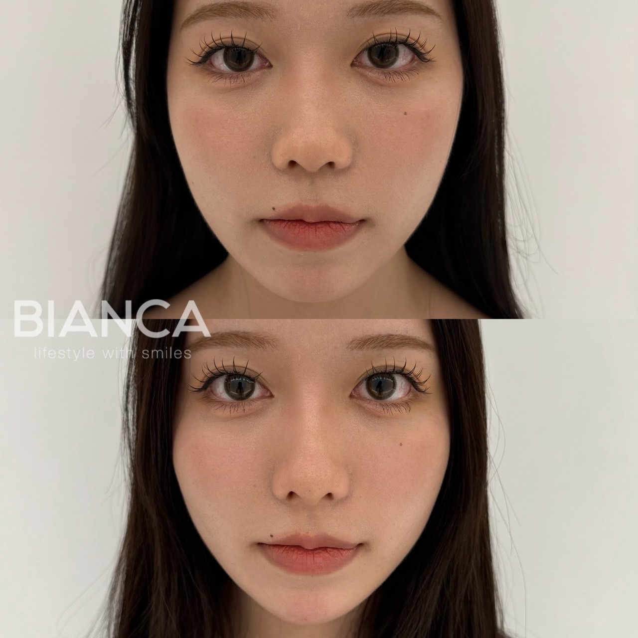 Eライン（顎・鼻）ヒアルロン酸注入