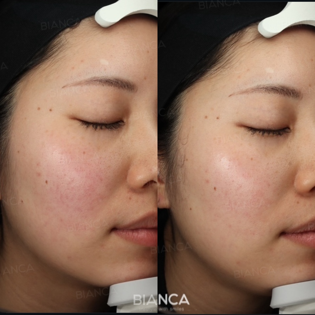 メソナJ（メソポレーション）