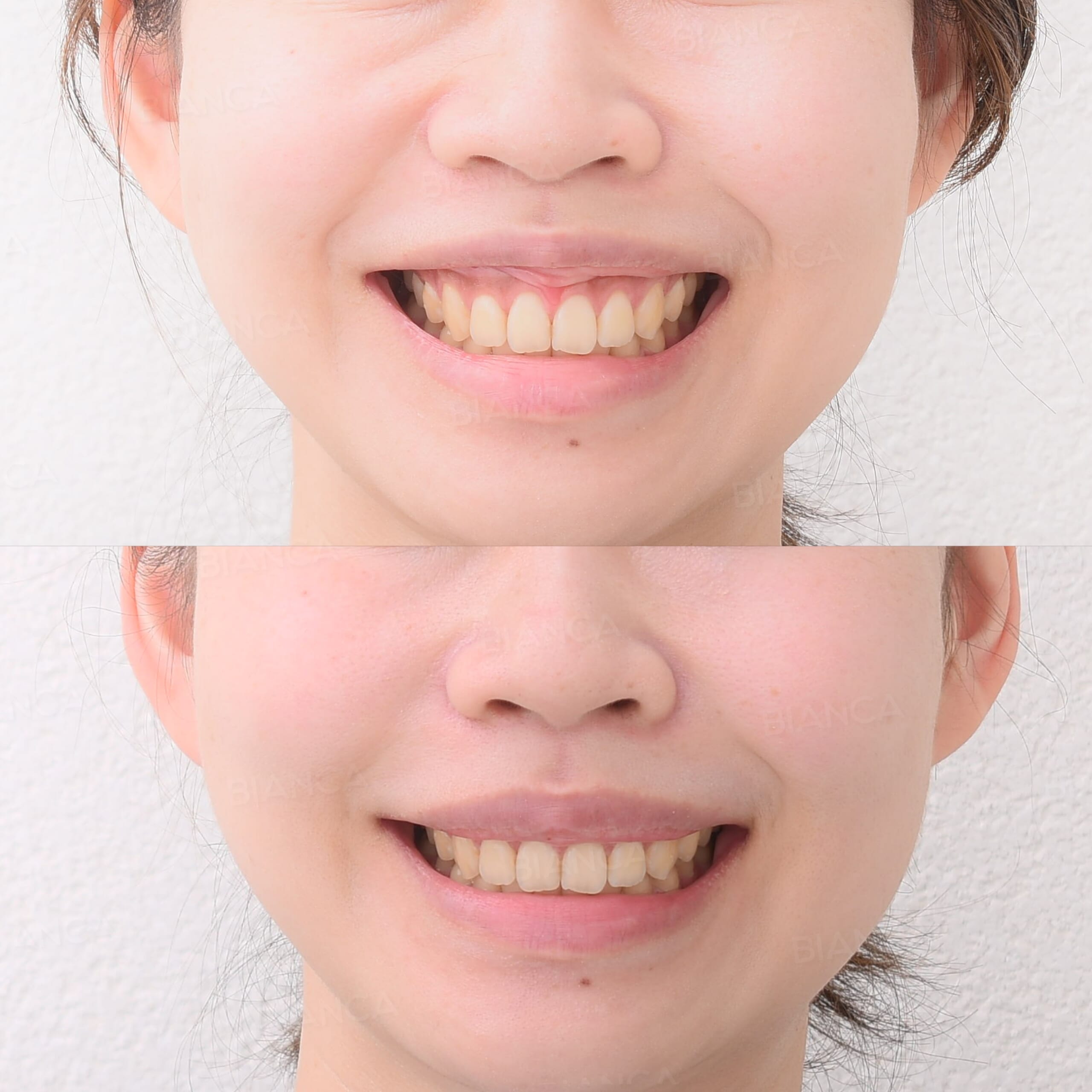 審美的歯冠長延長術・リップリポジショニング