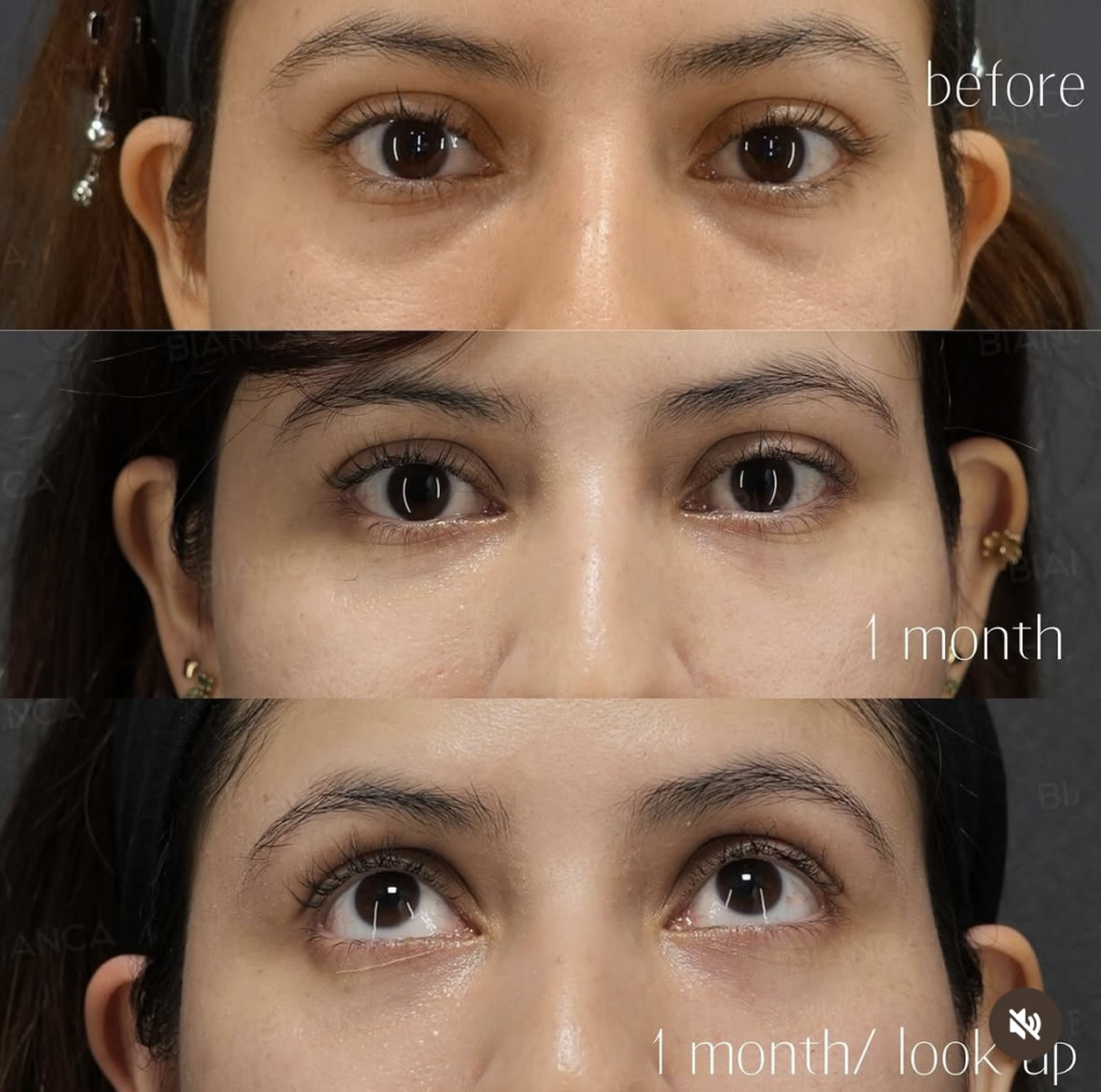 今BIANCAのベビーコラーゲンが熱い💉❤️‍🔥