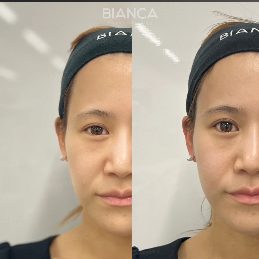 パーティーリフト（スマスアップネオ）