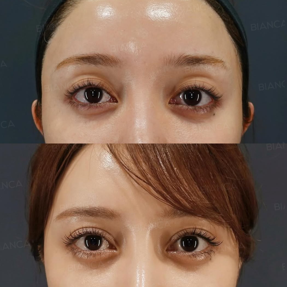 ヒアルロン酸注射(上瞼)