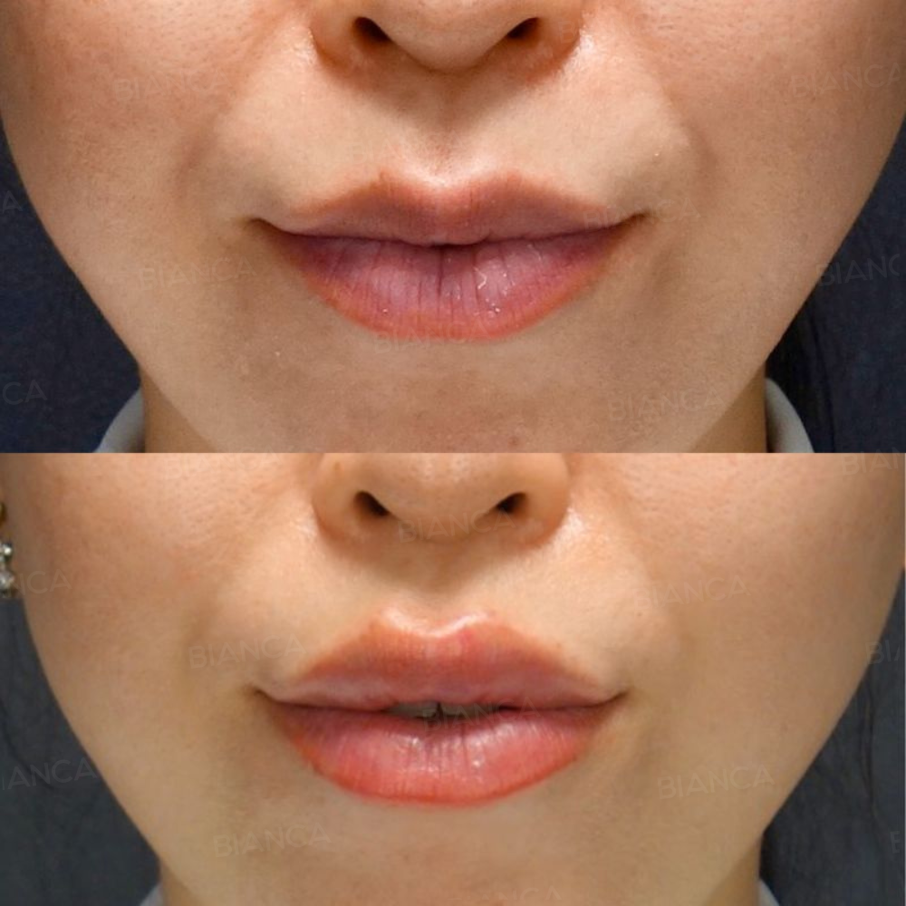 ヒアルロン酸注射（唇）