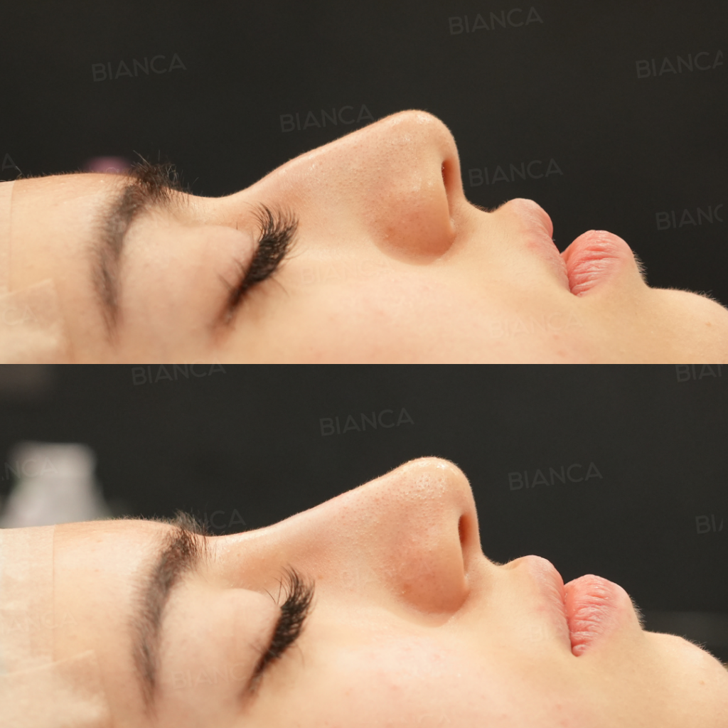 ヒアルロン酸注射（鼻）