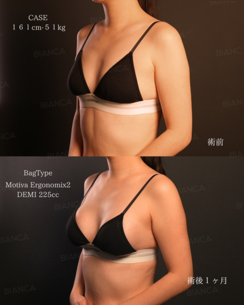 豊胸のデメリットとは？できなくなることが増えるって本当？｜ビアンカの美容外科医 雜賀 俊行が解説！