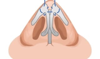 鼻尖縮小／鼻尖形成（だんご鼻修正） 銀座・表参道にあるBIANCA CLINIC ビアンカクリニック｜美容外科・美容皮膚科・再生医療・美容婦人科・美容内科・医療アートメイク