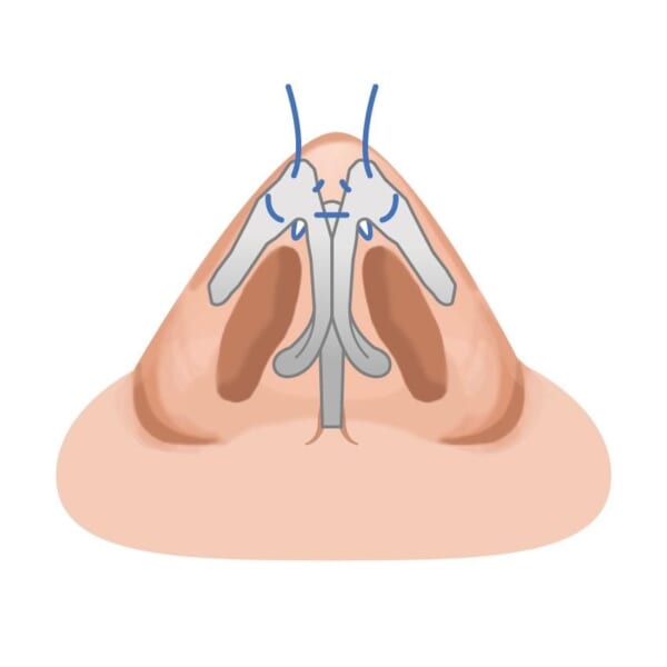 鼻尖縮小／鼻尖形成（だんご鼻修正） 銀座・表参道にあるBIANCA CLINIC ビアンカクリニック｜美容外科・美容皮膚科・再生医療・美容婦人科・美容内科・医療アートメイク