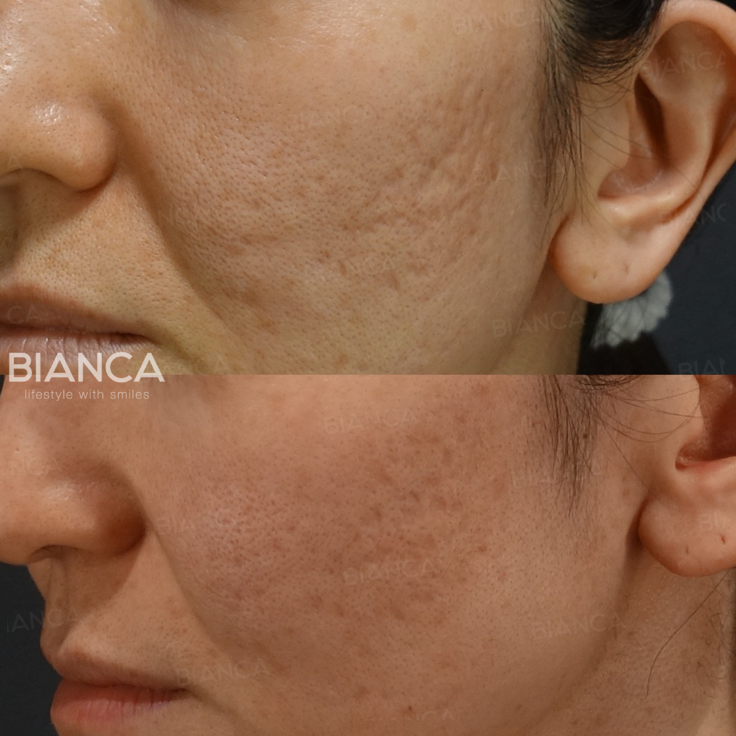 サブシジョン（クレーター治療）