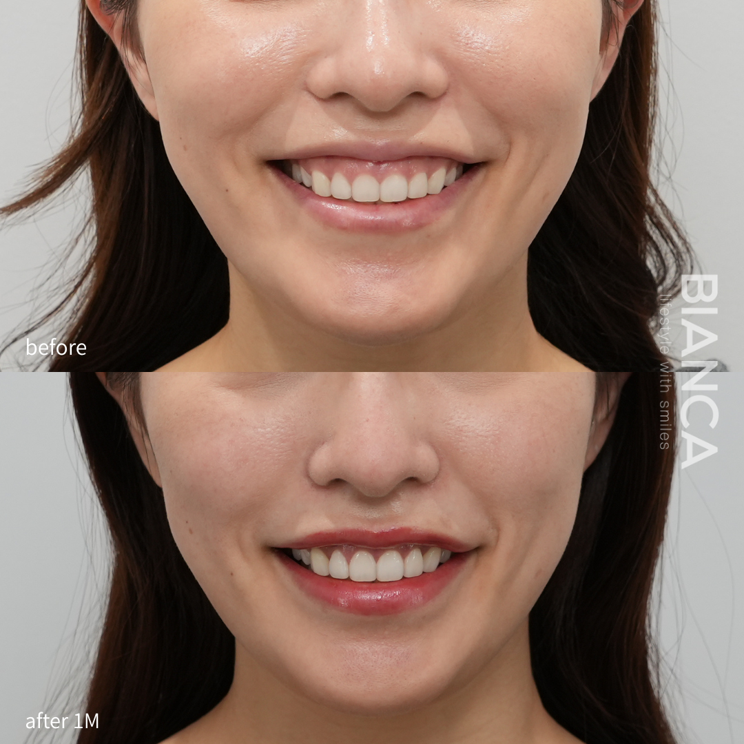 審美的歯冠長延長術