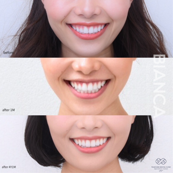 審美的歯冠長延長術