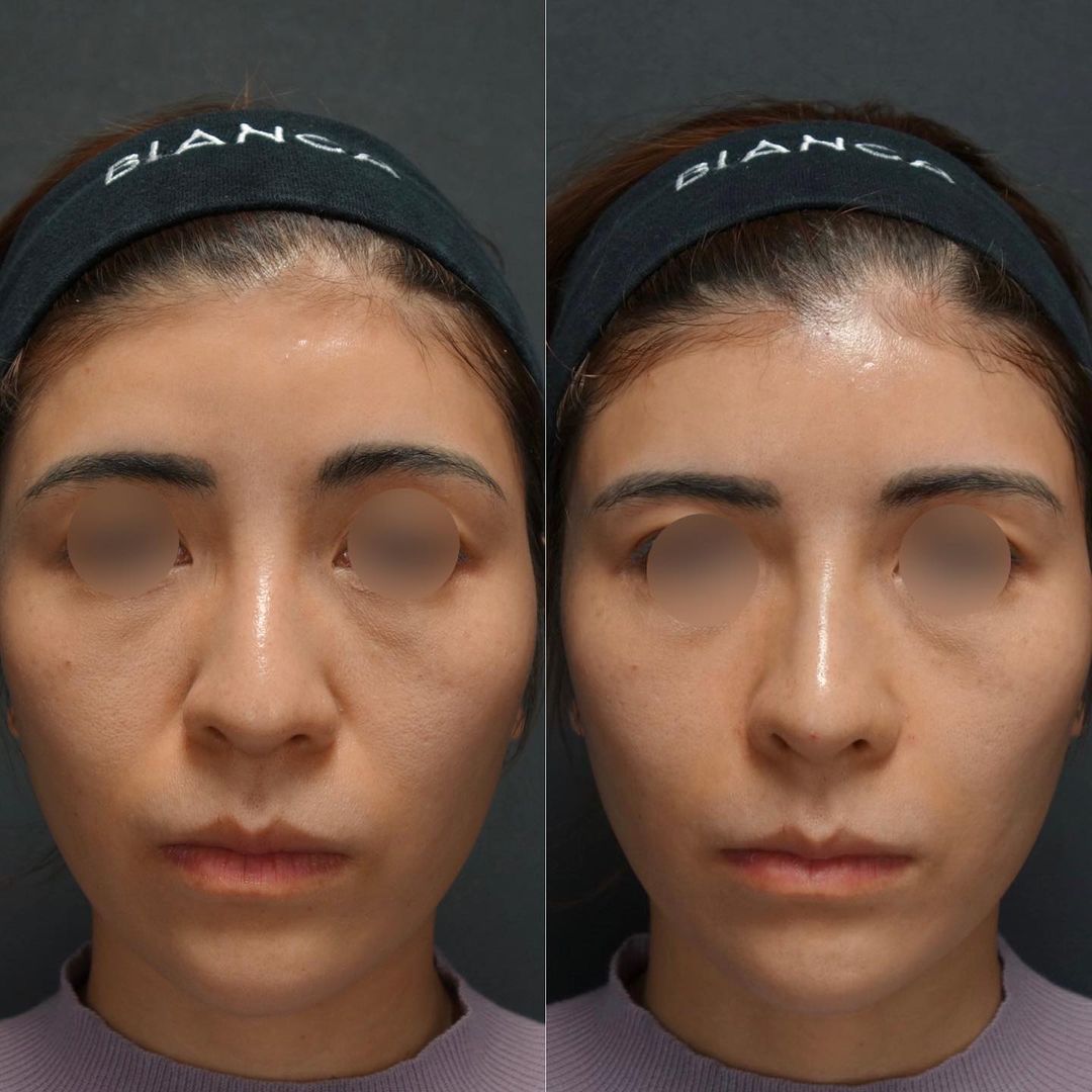 ヒアルロン酸注射（ほうれい線）