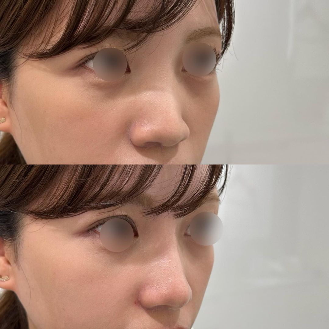 ヒアルロン酸注射（鼻）