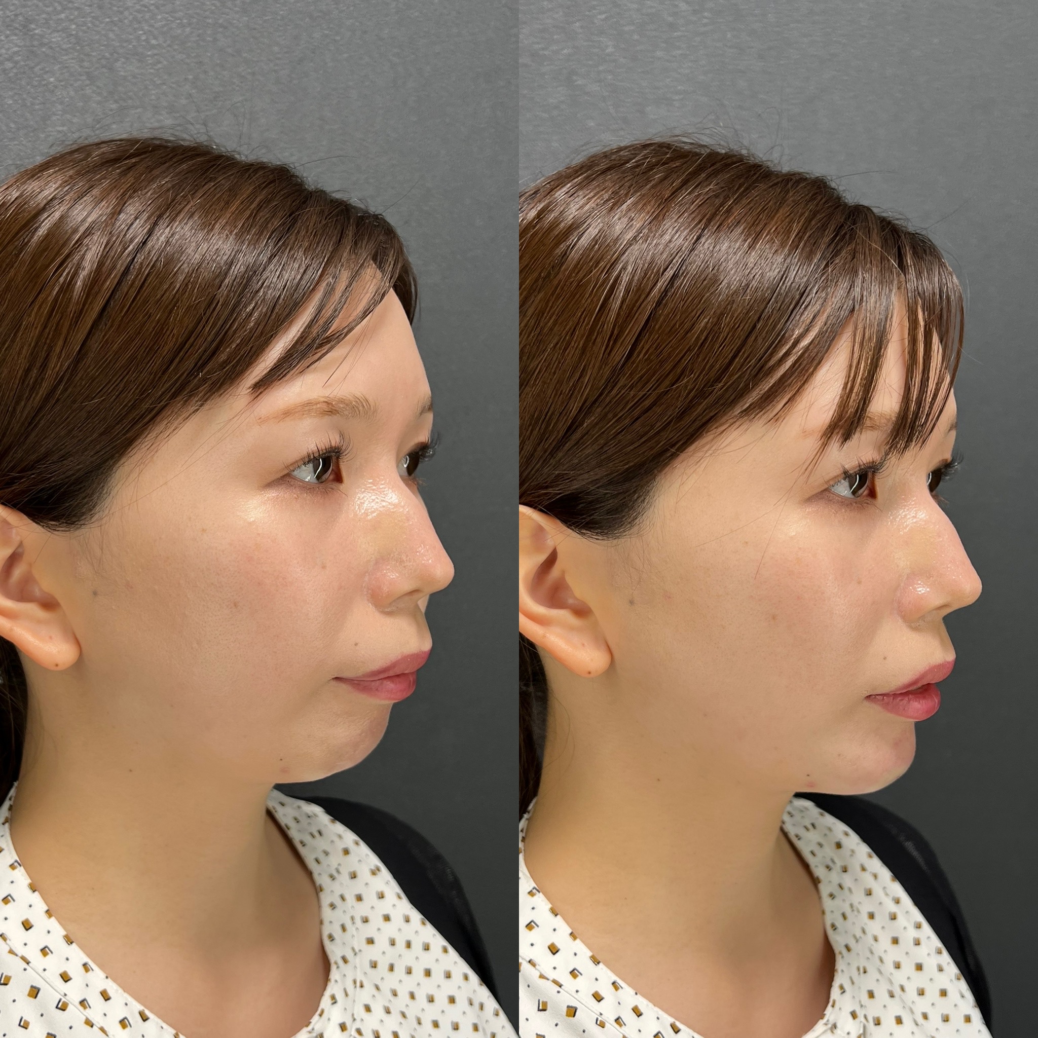 ヒアルロン酸注射（あご）