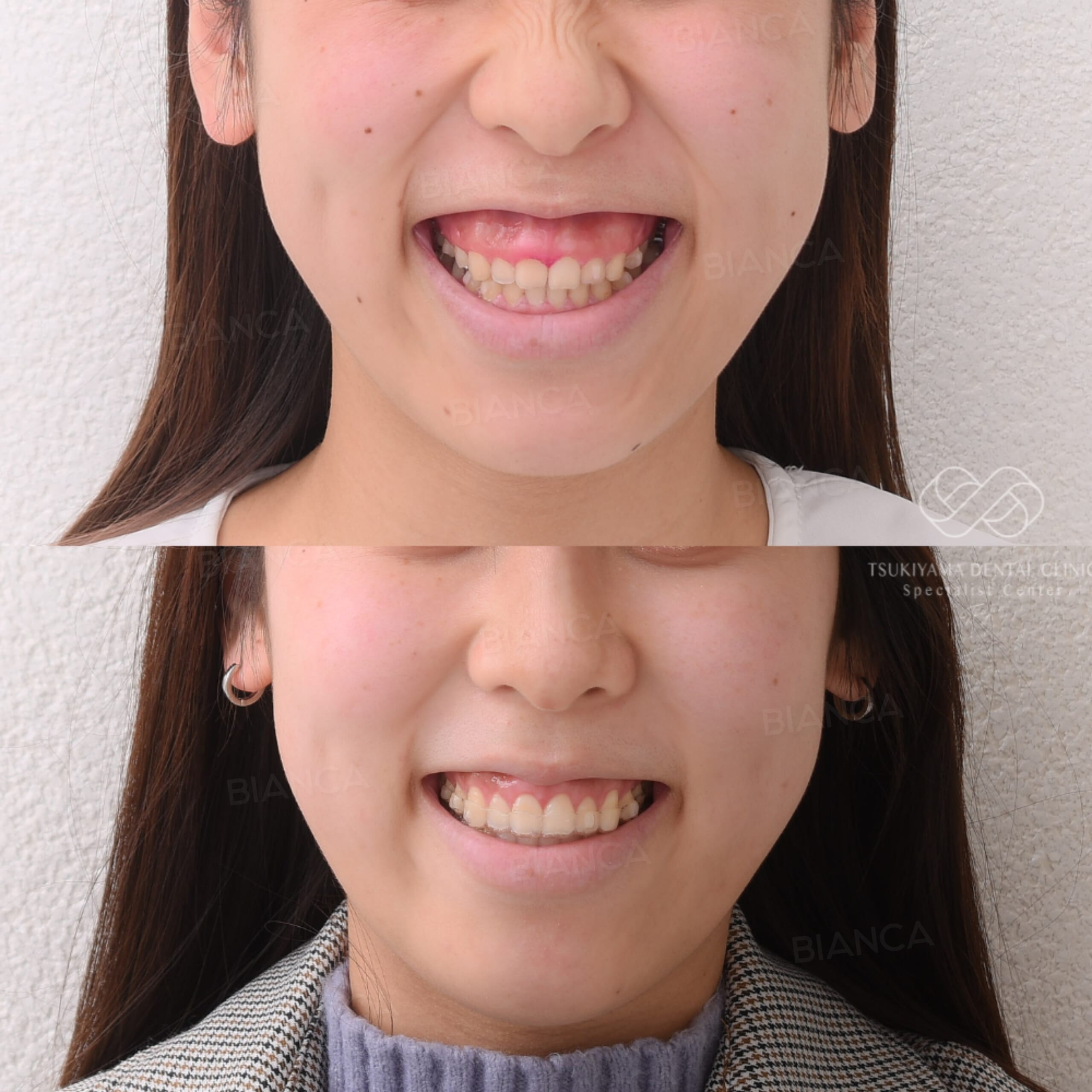 審美的歯冠長延長術・ボトックス注射