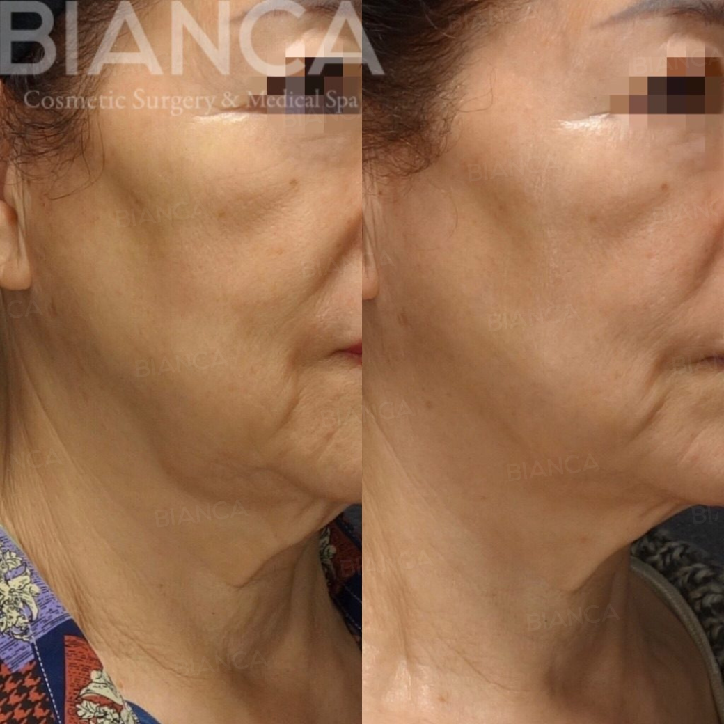 マッサージピール