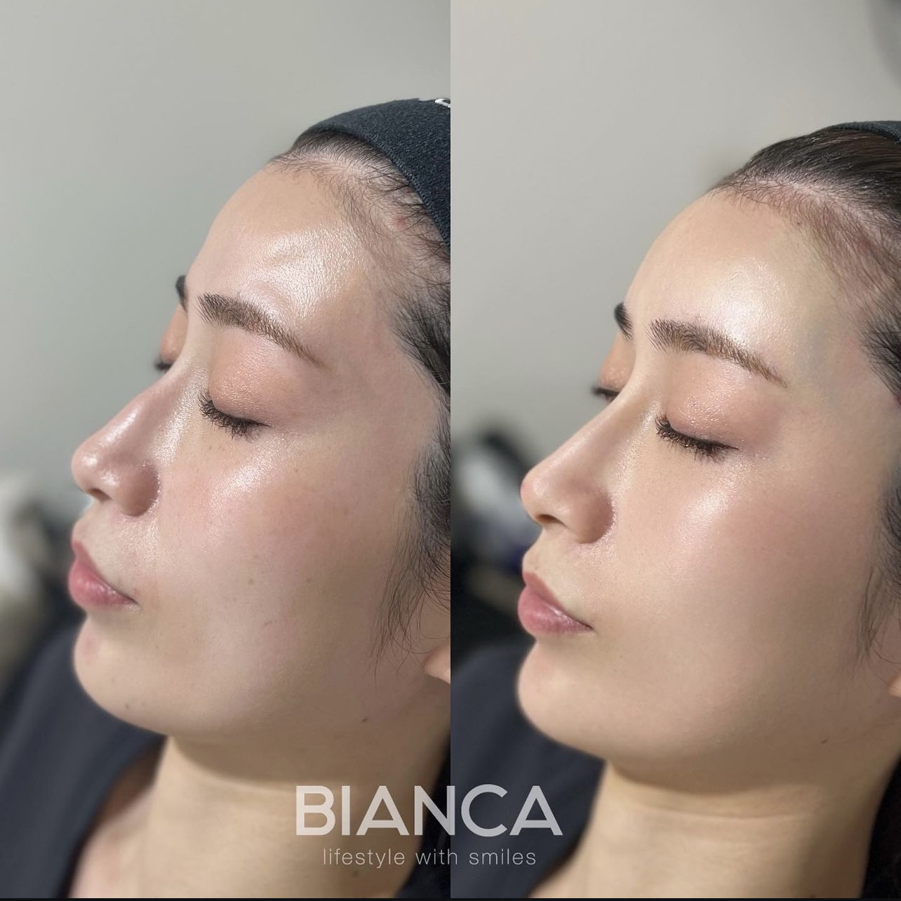 ヒアルロン酸注射