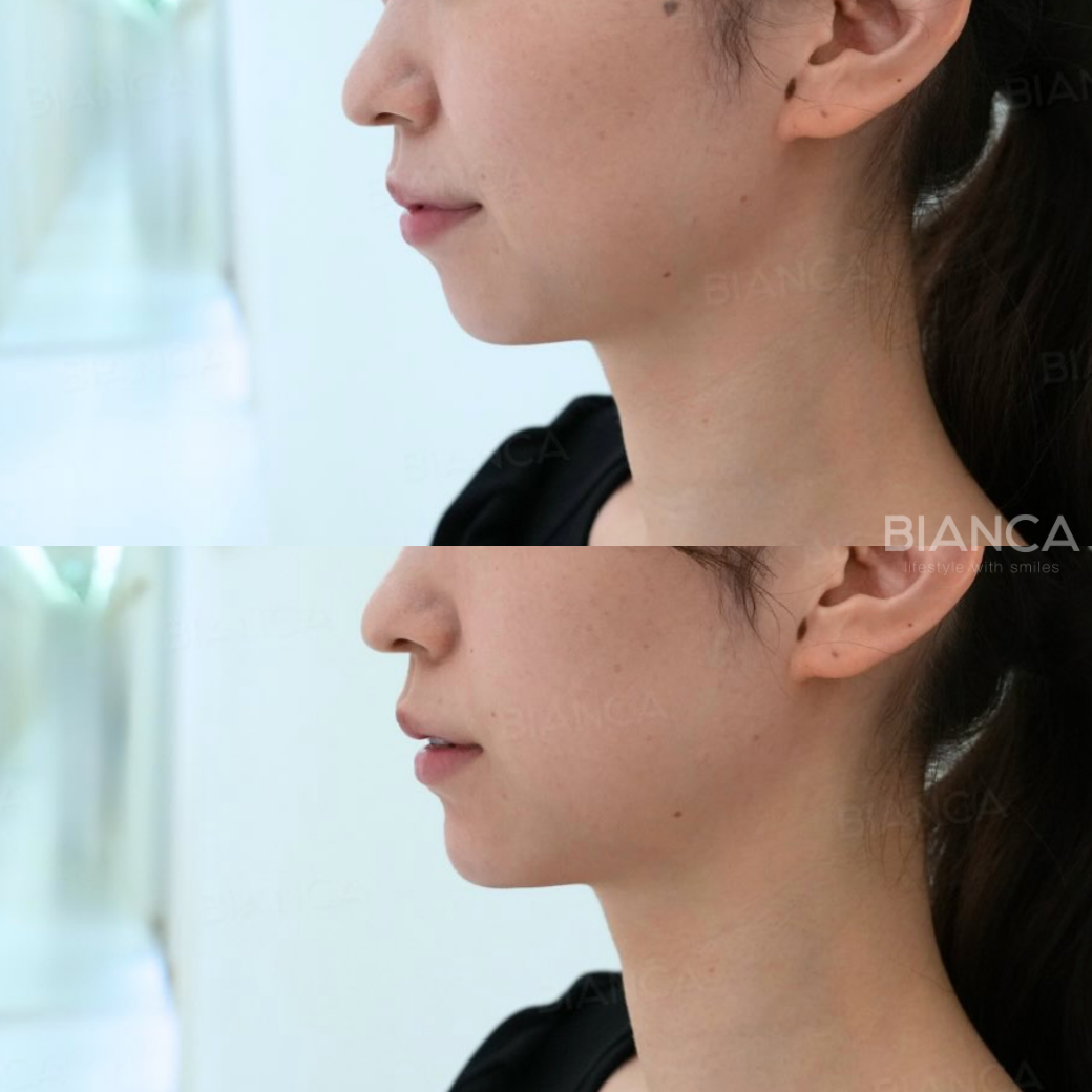 テオシアル（あご）