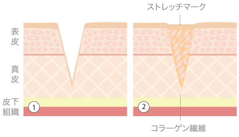 ストレッチマークはなぜできる？原因と治療アプローチ