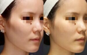 ヒアルロン酸注射（頬こけ）｜銀座・表参道にあるBIANCA CLINIC ビアンカクリニック｜美容外科・美容皮膚科・再生医療・美容婦人科・美容内科