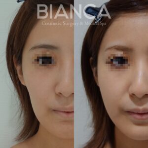 ヒアルロン酸注射（頬こけ）