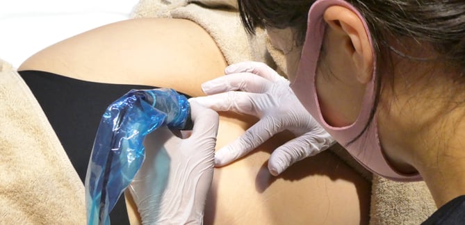 麻酔なしで施術ができるほど痛みが少ない