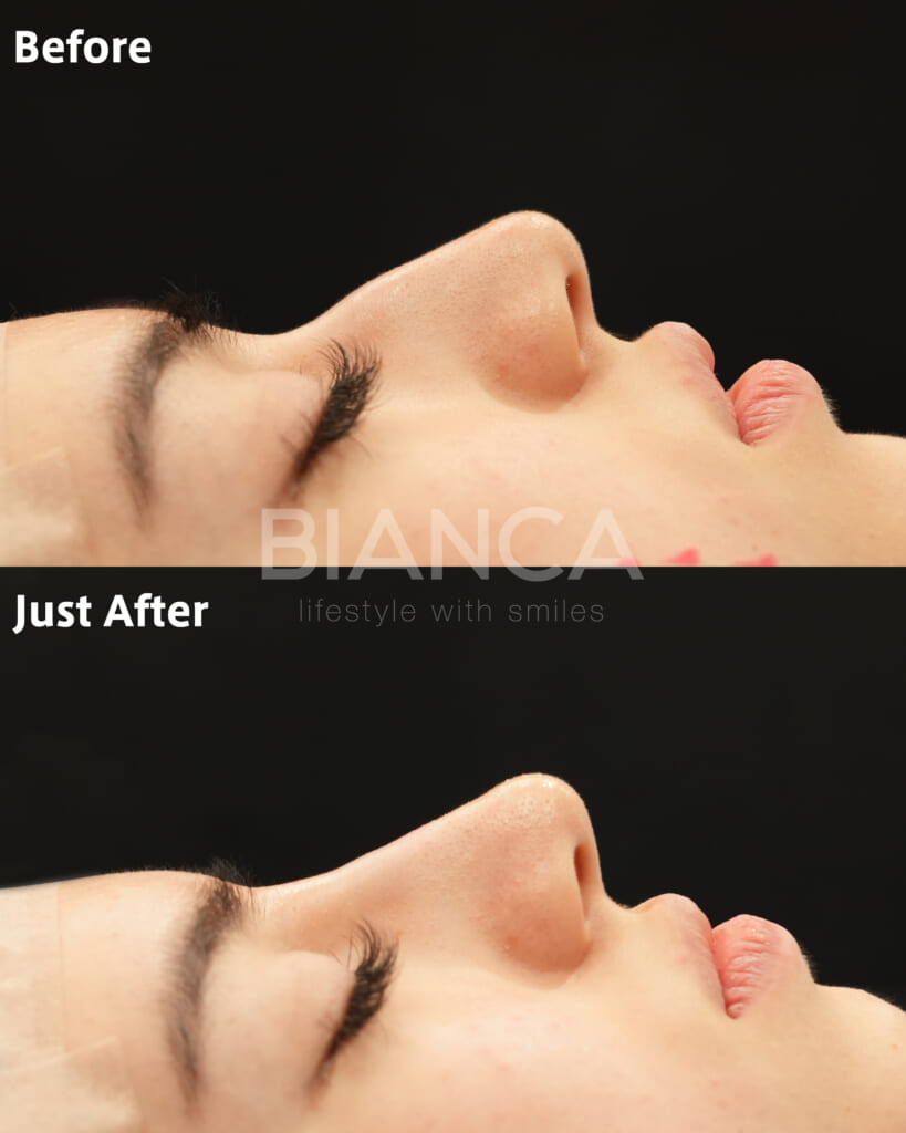 ヒアルロン酸注射（鼻）