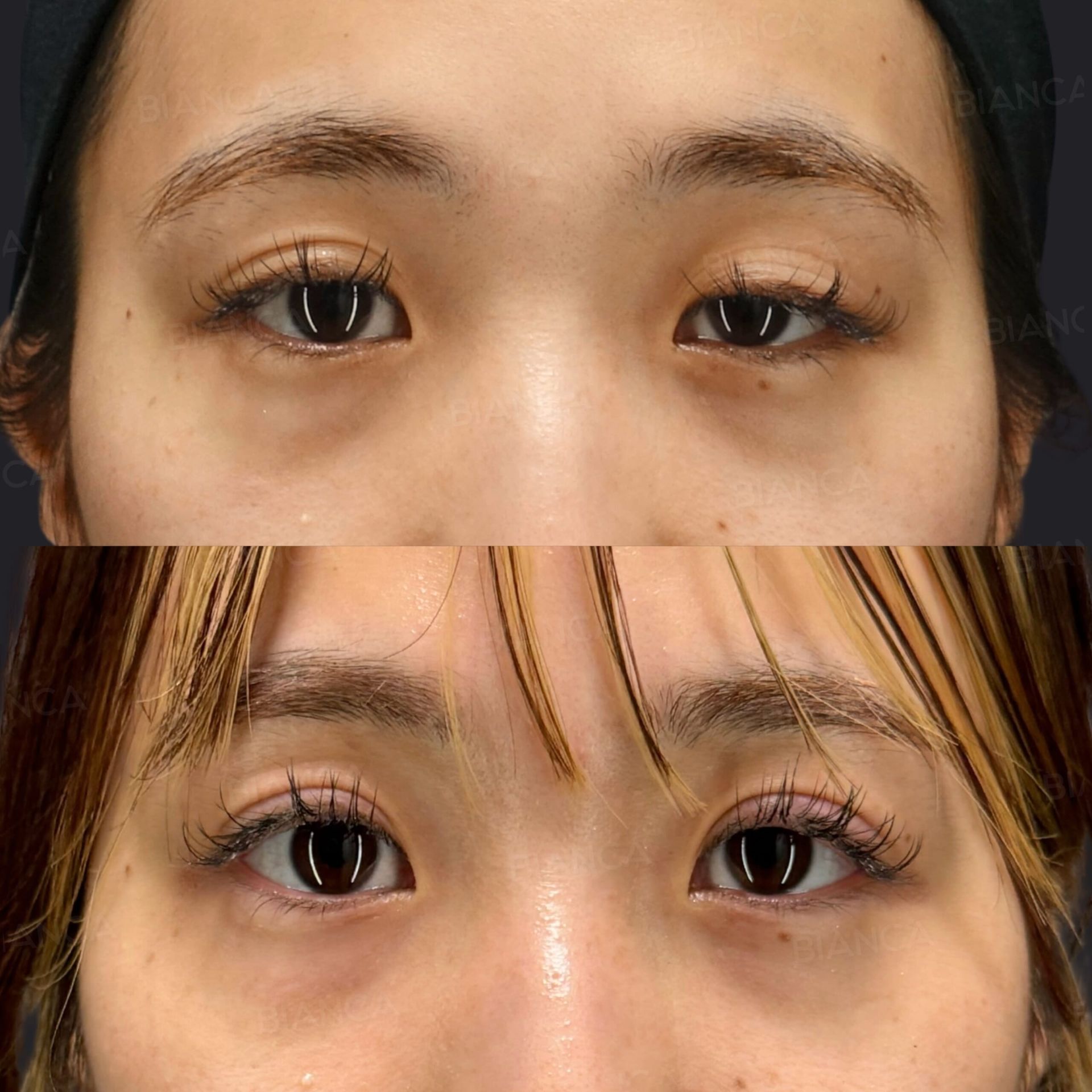 眼瞼下垂切開法