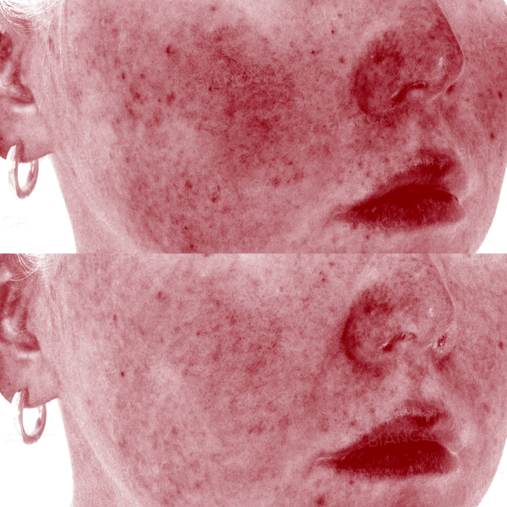 肌質改善(メソナJ)、ルメッカ、VISIA