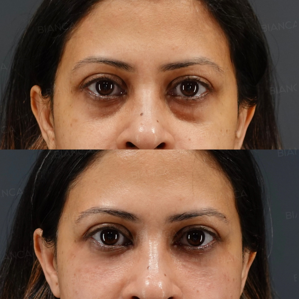 ベビーコラーゲン（目の下）、ヒアルロン酸注射（ゴルゴライン）