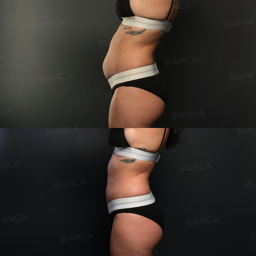 ベイザー(VASER)ボディ脂肪吸引(全腹部+腰部)