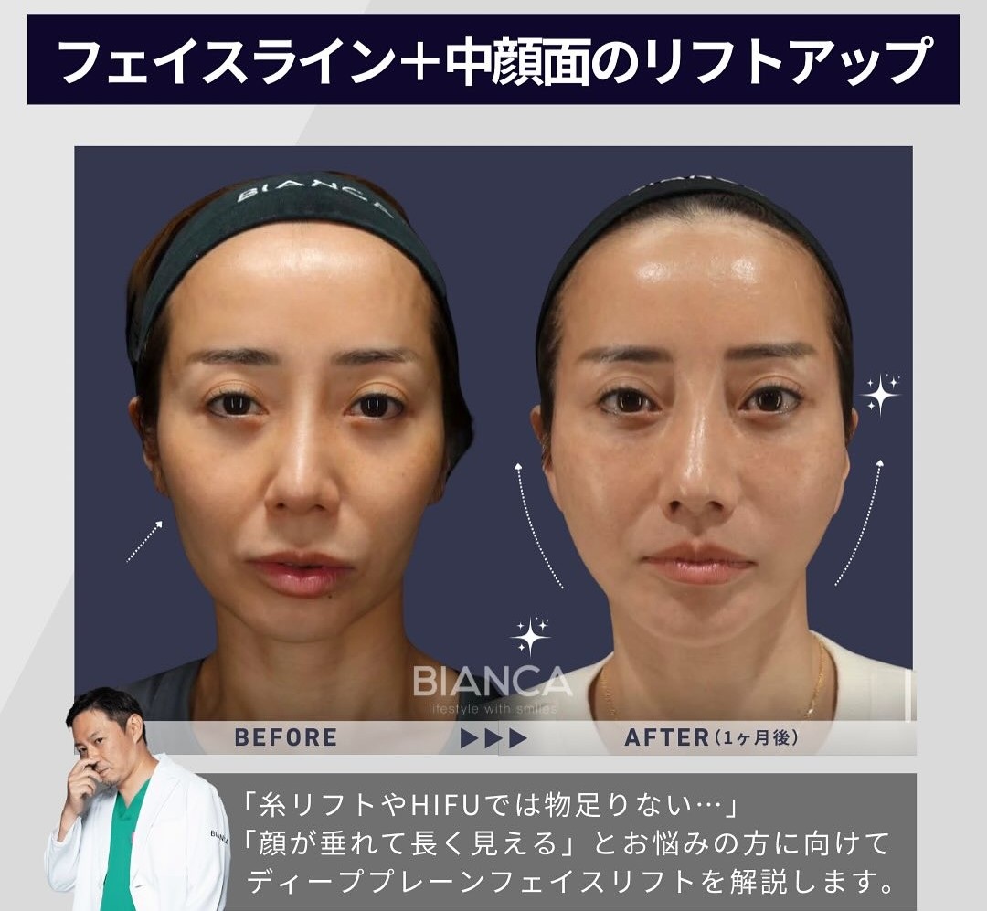 ディーププレーンフェイスリフトとは