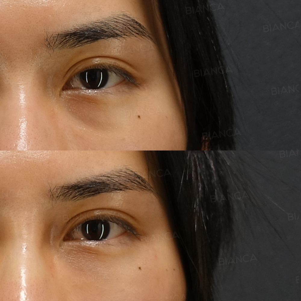 ベビーコラーゲン(目の下)