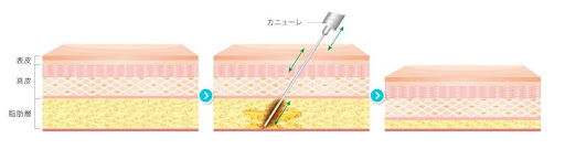 脂肪細胞を吸引するためリバウンドしにくい