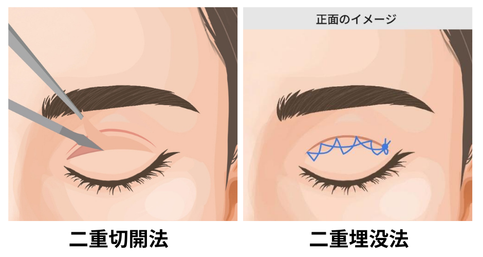 「二重切開法」と「二重埋没法」の違い