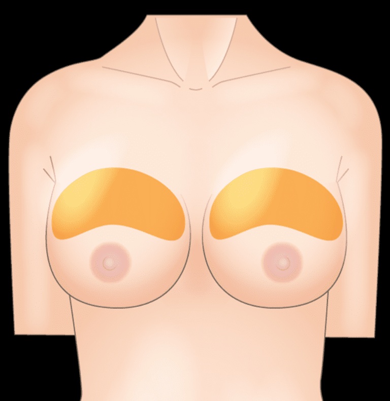  下垂や左右差といった形状のお悩みも解消
