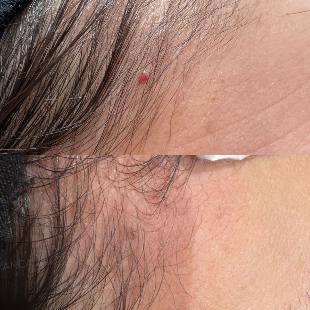 ADVATxレーザー(スポット照射  老人性血管腫)