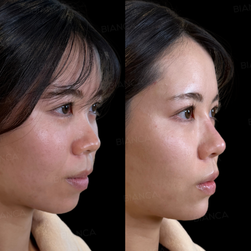 ヒアルロン酸注射(鼻、鼻翼基部、顎）