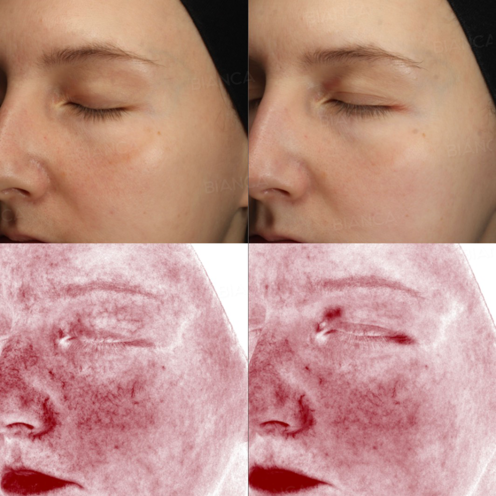 ADVATxレーザー(オーダーメイド2波長全顔）