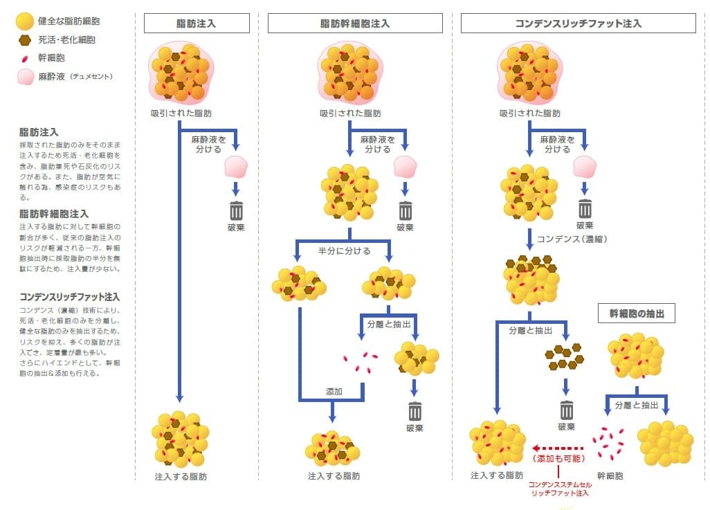 コンデンスリッチフェイス（CRF）とは