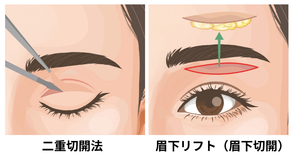 「二重切開法」と「眉下リフト（眉下切開）」の違い