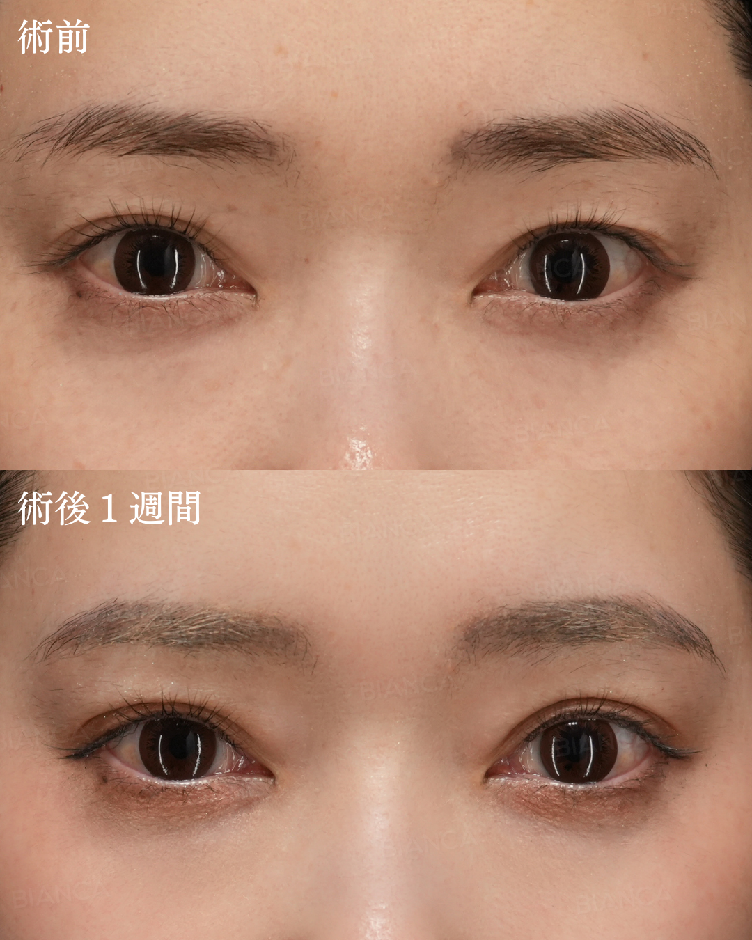 二重埋没法（裏留め）