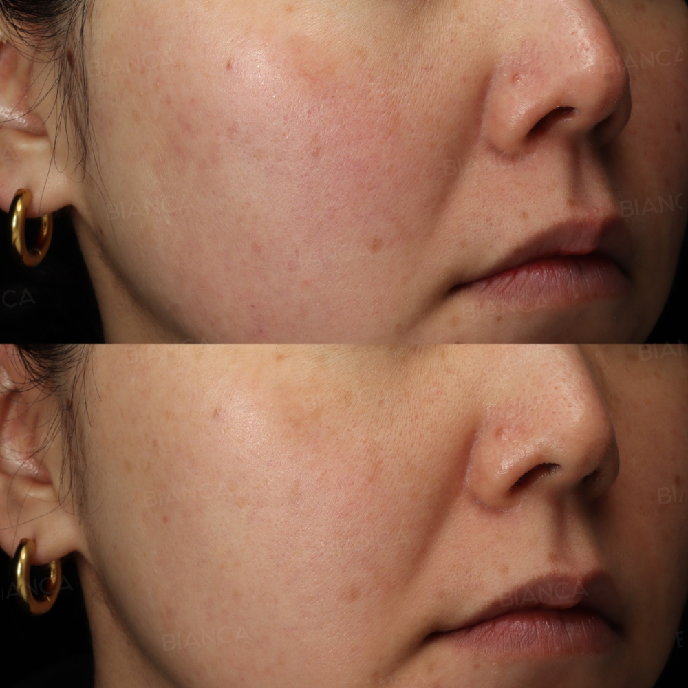 肌質改善(メソナJ),ルメッカ